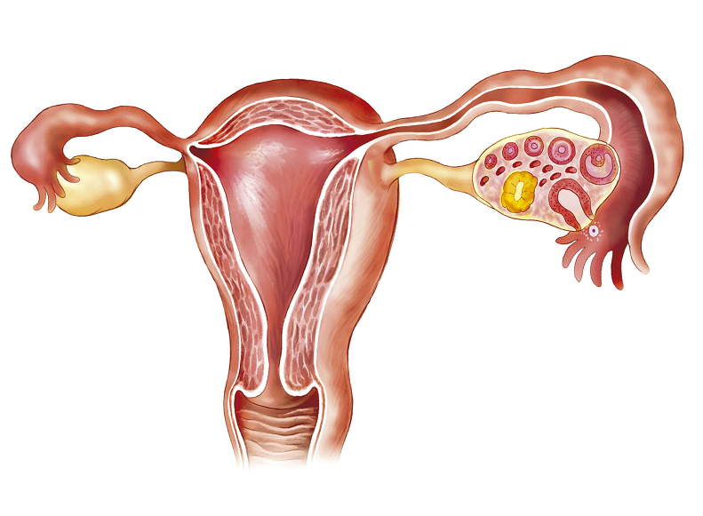 多囊卵巢综合征是什么意思？听听我院老中医讲解