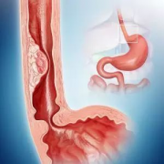 反流性食管炎有哪些注意事项以及反流性食管炎的五大饮食原则。